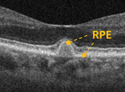 Druse with RPE over lesion 