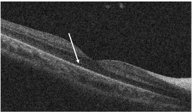 OCT myelinated retinal nerve