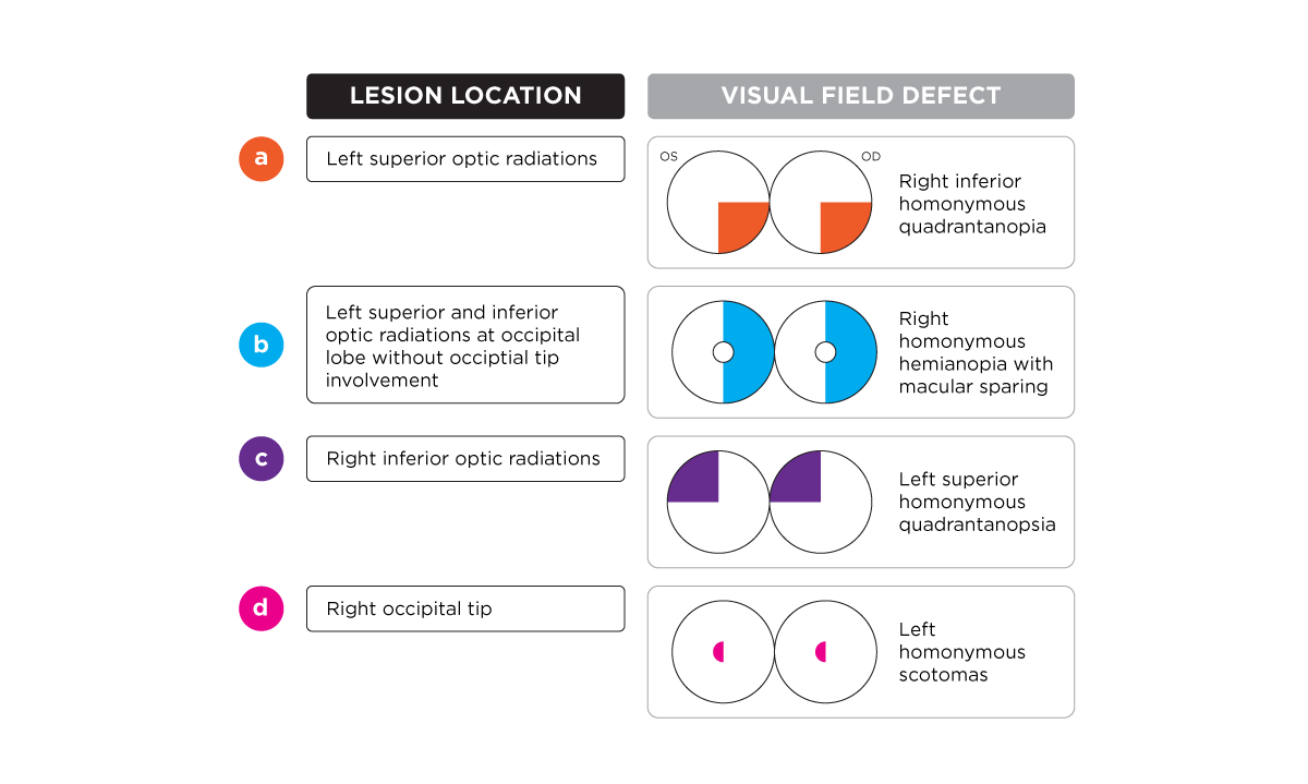 CB lesion location and visual field defect