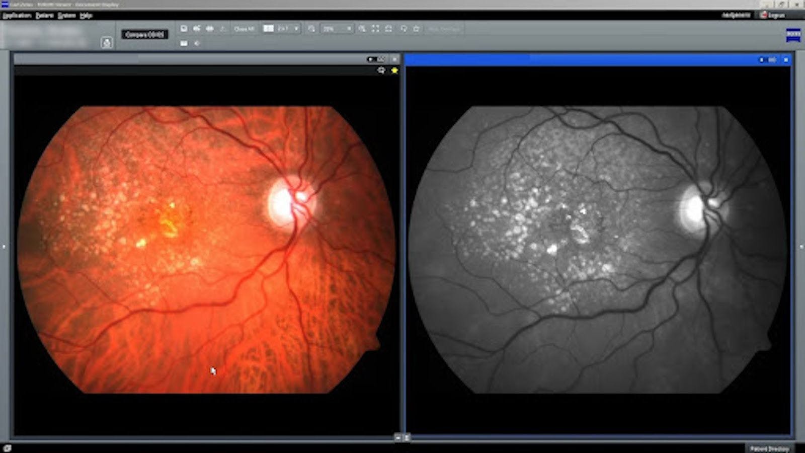 Macular degeneration without neovascularization