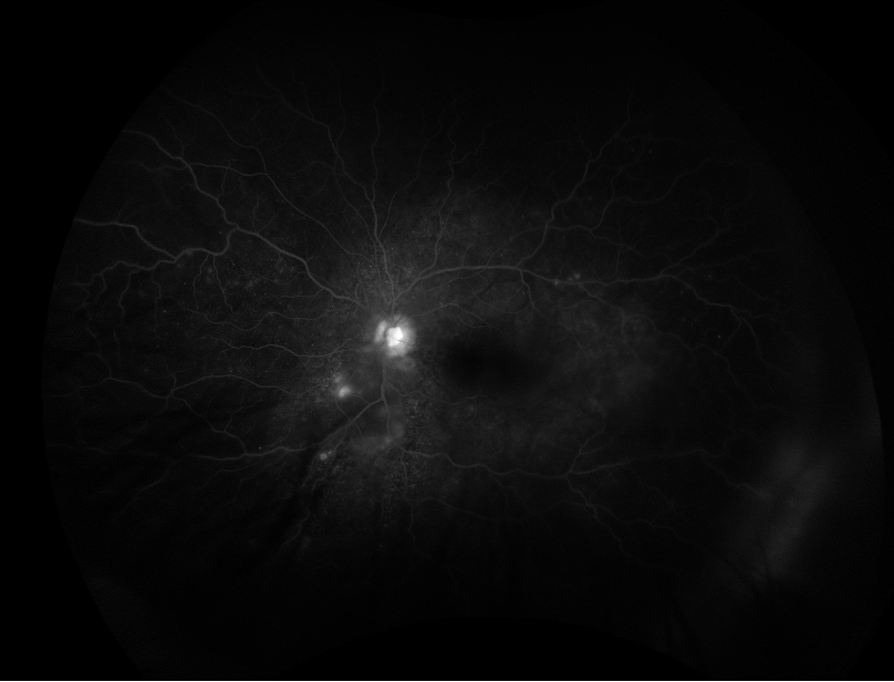 Fluorescein Angiography