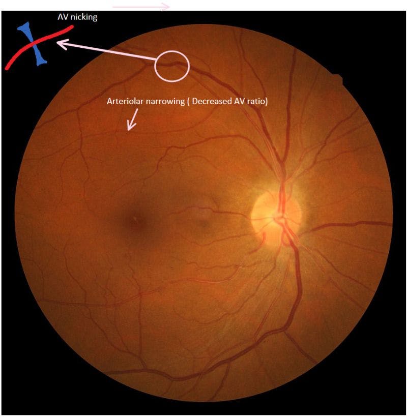 Arteriovenous Nicking Hypertensive Retinopathy