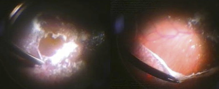 Triamcinolone acetonide staining