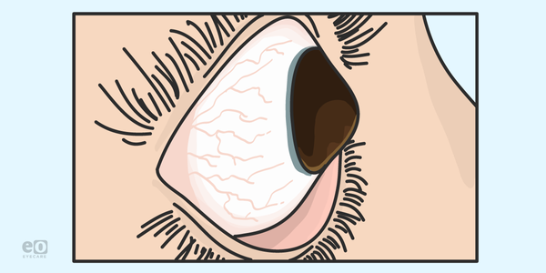 Navigating the Anterior Segment with Scleral Lens Focus