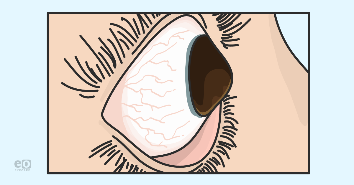 Navigating the Anterior Segment with Scleral Lens Focus