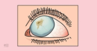 How to Treat Corneal Scarring: A Resident's Guide