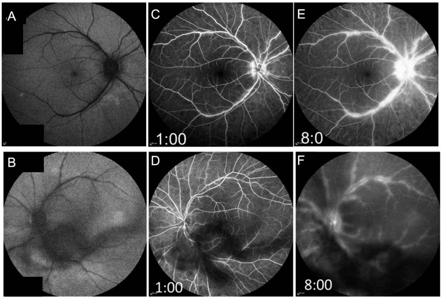 Retinal Vasculitis