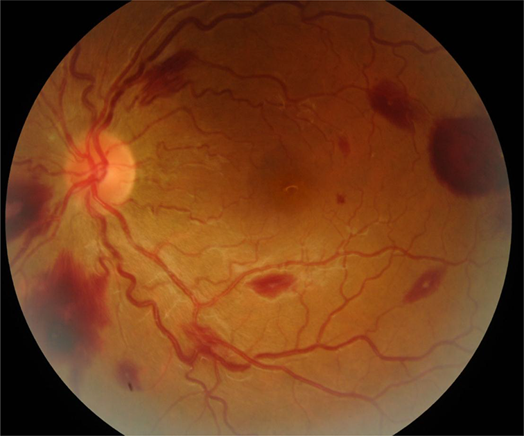 Fundus Roth Spots