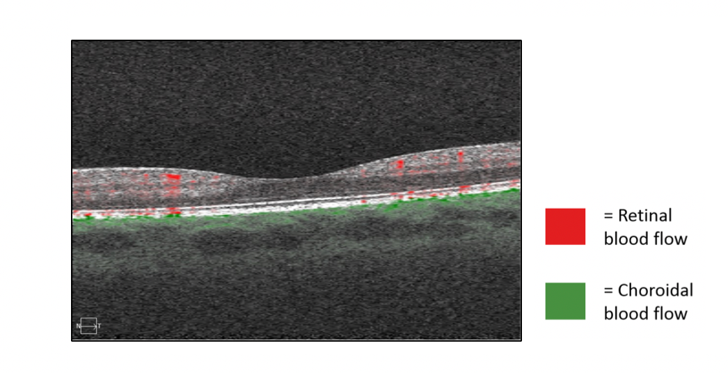 OCTA scans and retinal blood flow analysis