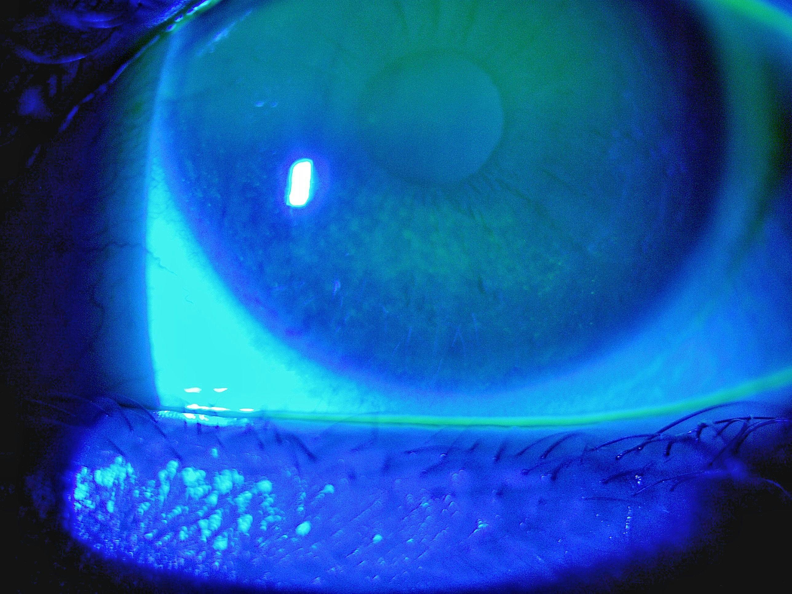 Corneal staining