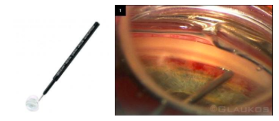 swans-jacobs-direct-gonioscopy-lens-view.png
