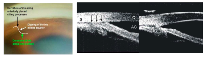 gonioscopy-plateau-iris.png