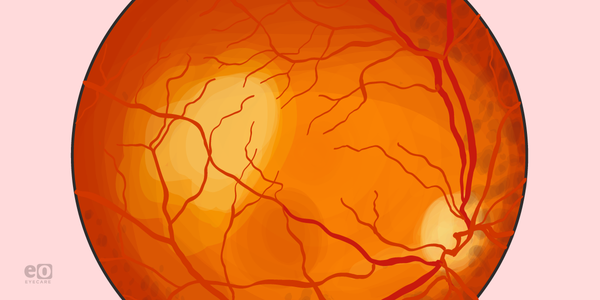 Identifying Choroidal Metastasis: A Resident's Guide