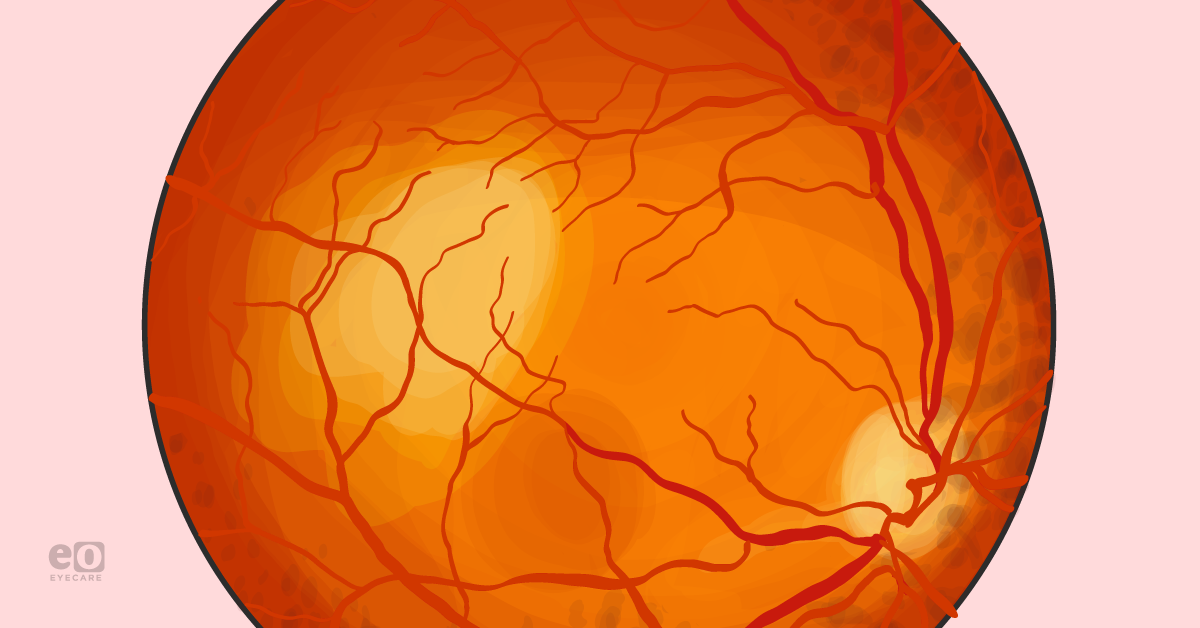 Identifying Choroidal Metastasis: A Resident's Guide