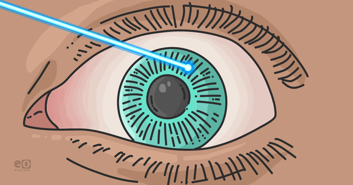 5 Clinical Pearls for Iridotomy for Glaucoma