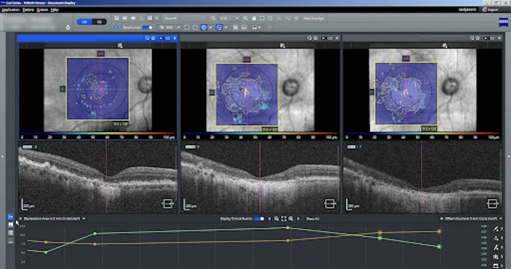 Sub-RPE illumination indicates geographic atrophy