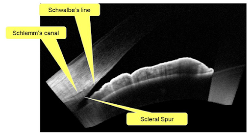 https://covalentcareers3.s3.amazonaws.com/media/original_images/AS-OCT_of_anterior_chamber_angle.png