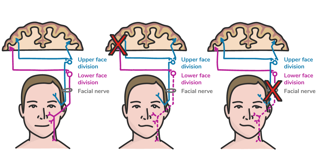 https://covalentcareers3.s3.amazonaws.com/media/original_images/Bells-Palsy_Article_Image-insert_4jT6qKm.png