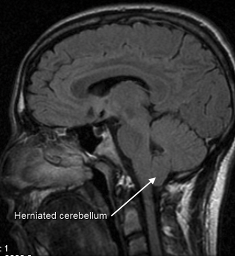 https://covalentcareers3.s3.amazonaws.com/media/original_images/Chiari_malformation_and_herniated_cerebellum.png