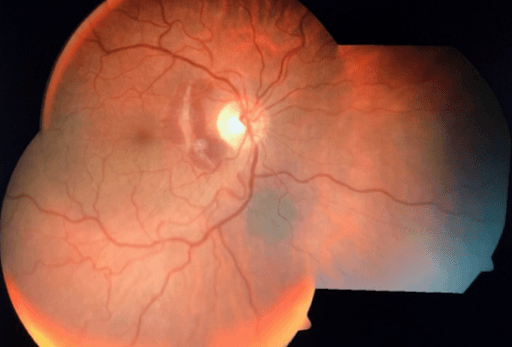 https://covalentcareers3.s3.amazonaws.com/media/original_images/Choroidal-Rupture-nasal-macula.png