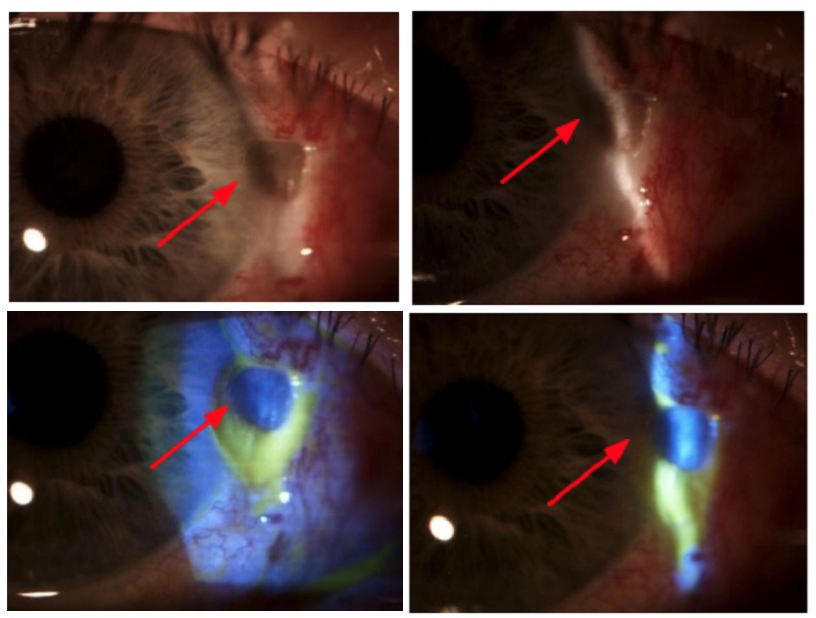 https://covalentcareers3.s3.amazonaws.com/media/original_images/Corneal_Dellan-4_Slit_Lamp_Views.png