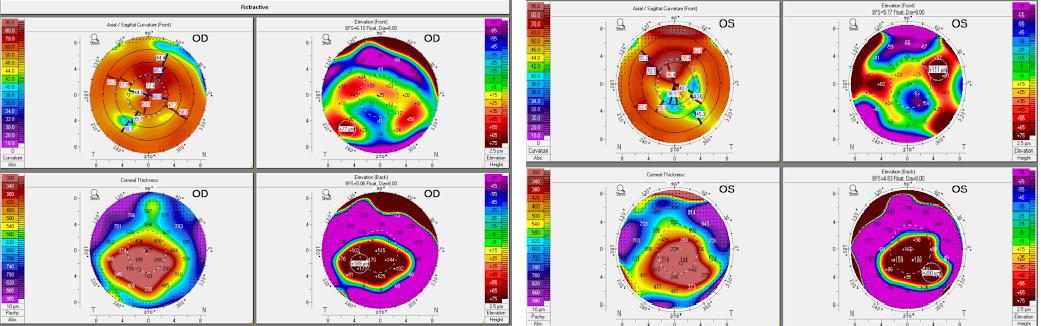 https://covalentcareers3.s3.amazonaws.com/media/original_images/Corneal_topography.png