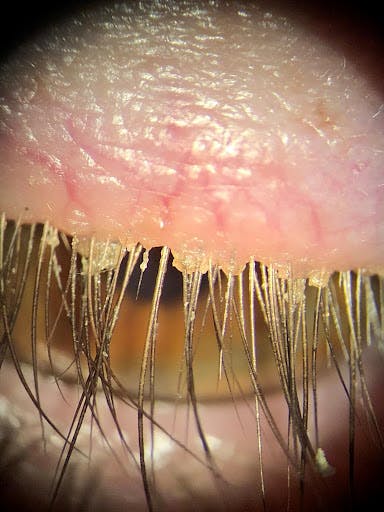 https://covalentcareers3.s3.amazonaws.com/media/original_images/Demodex_folliculorum_collarettes.jpg