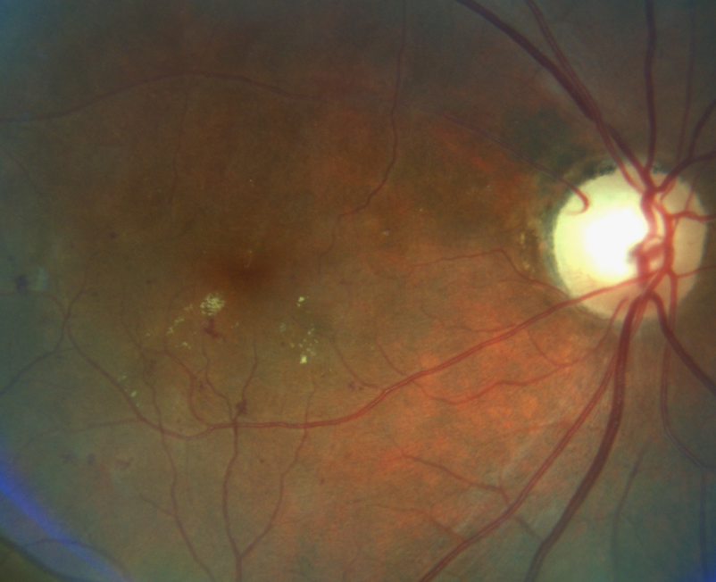 https://covalentcareers3.s3.amazonaws.com/media/original_images/Diabetic-Retinopathy-NAION-Fundus-Photo.png