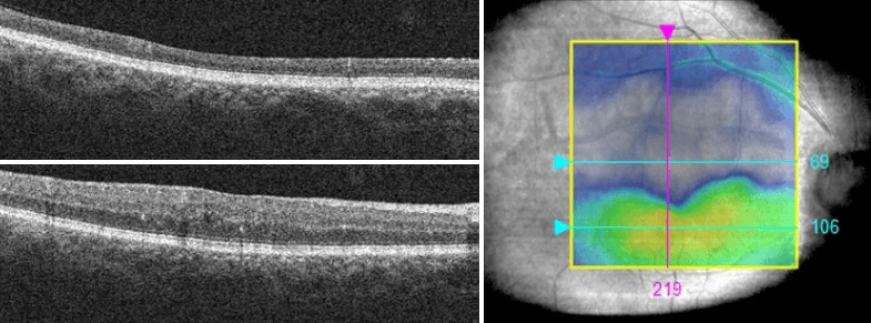 https://covalentcareers3.s3.amazonaws.com/media/original_images/Diabetic-Retinopathy-NAION-OCT.png