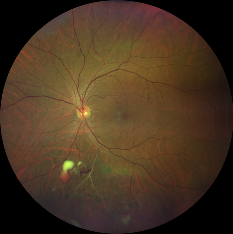 https://covalentcareers3.s3.amazonaws.com/media/original_images/Diabetic-Retinopathy-Retinal-Artery-Occulsions.png