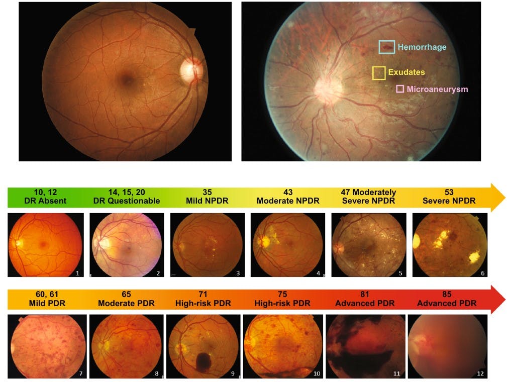 https://covalentcareers3.s3.amazonaws.com/media/original_images/Diabetic_Retinopathy_Grading_Figure_3.jpg