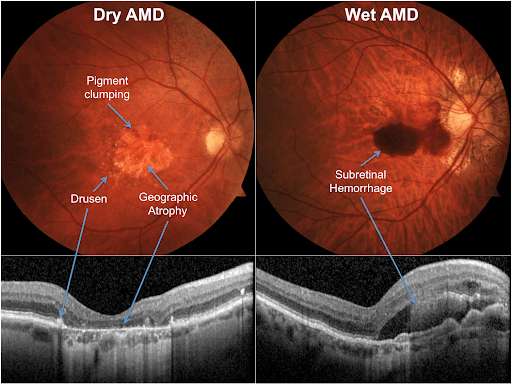 https://covalentcareers3.s3.amazonaws.com/media/original_images/Dry_vs_Wet_AMD.png