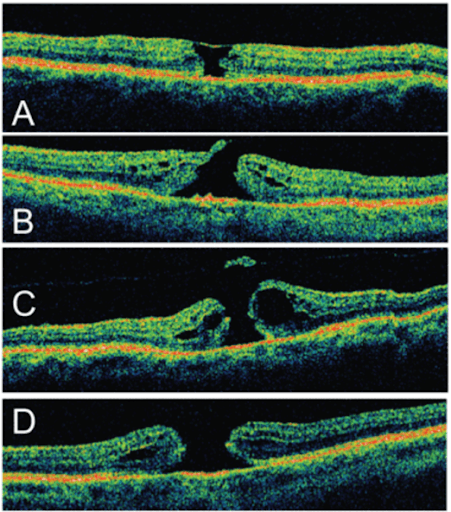 https://covalentcareers3.s3.amazonaws.com/media/original_images/Four_stages_of_macular_hole.png