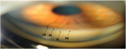 https://covalentcareers3.s3.amazonaws.com/media/original_images/Gonioscopy_view_of_angle_structures.png