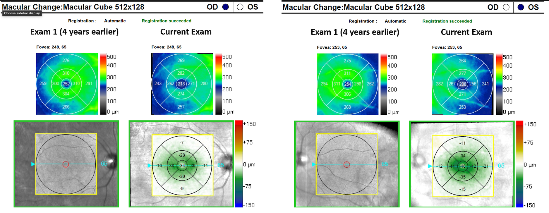 https://covalentcareers3.s3.amazonaws.com/media/original_images/Hydroxychloroquine_Retinopathy_progression.png