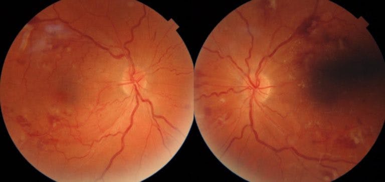 https://covalentcareers3.s3.amazonaws.com/media/original_images/Hypertensive-Retinopathy-1-768x363.jpg