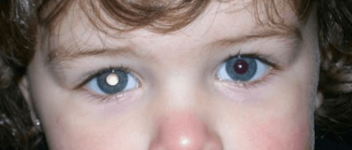 https://covalentcareers3.s3.amazonaws.com/media/original_images/Leukocoria-Retinoblastoma.png