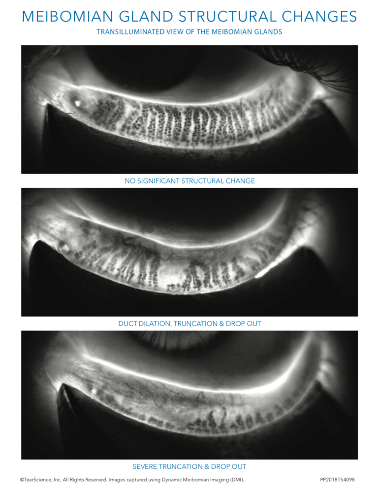 https://covalentcareers3.s3.amazonaws.com/media/original_images/Meibomian-Gland-Structural-Changes-768x996.png