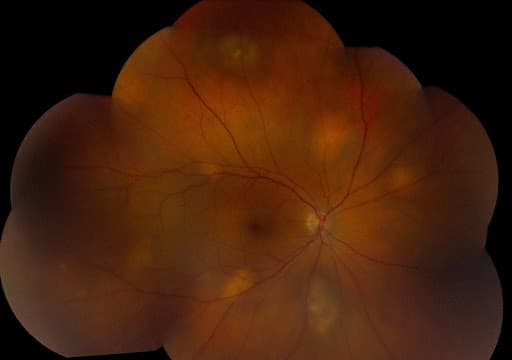 https://covalentcareers3.s3.amazonaws.com/media/original_images/Multifocal_Choroidal_Metastasis.jpg