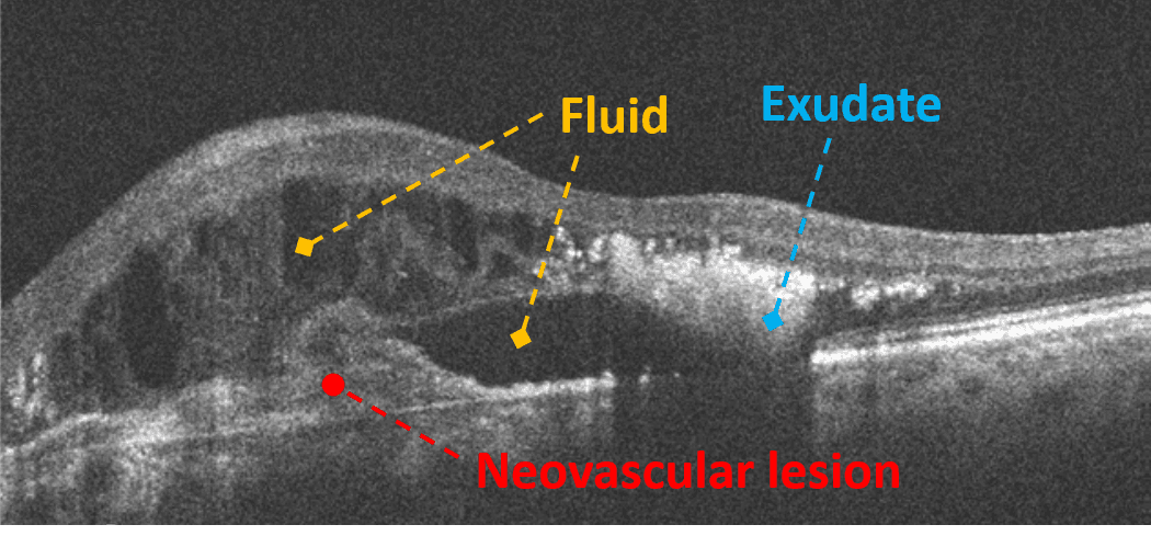 https://covalentcareers3.s3.amazonaws.com/media/original_images/Neovascular_lesion.png