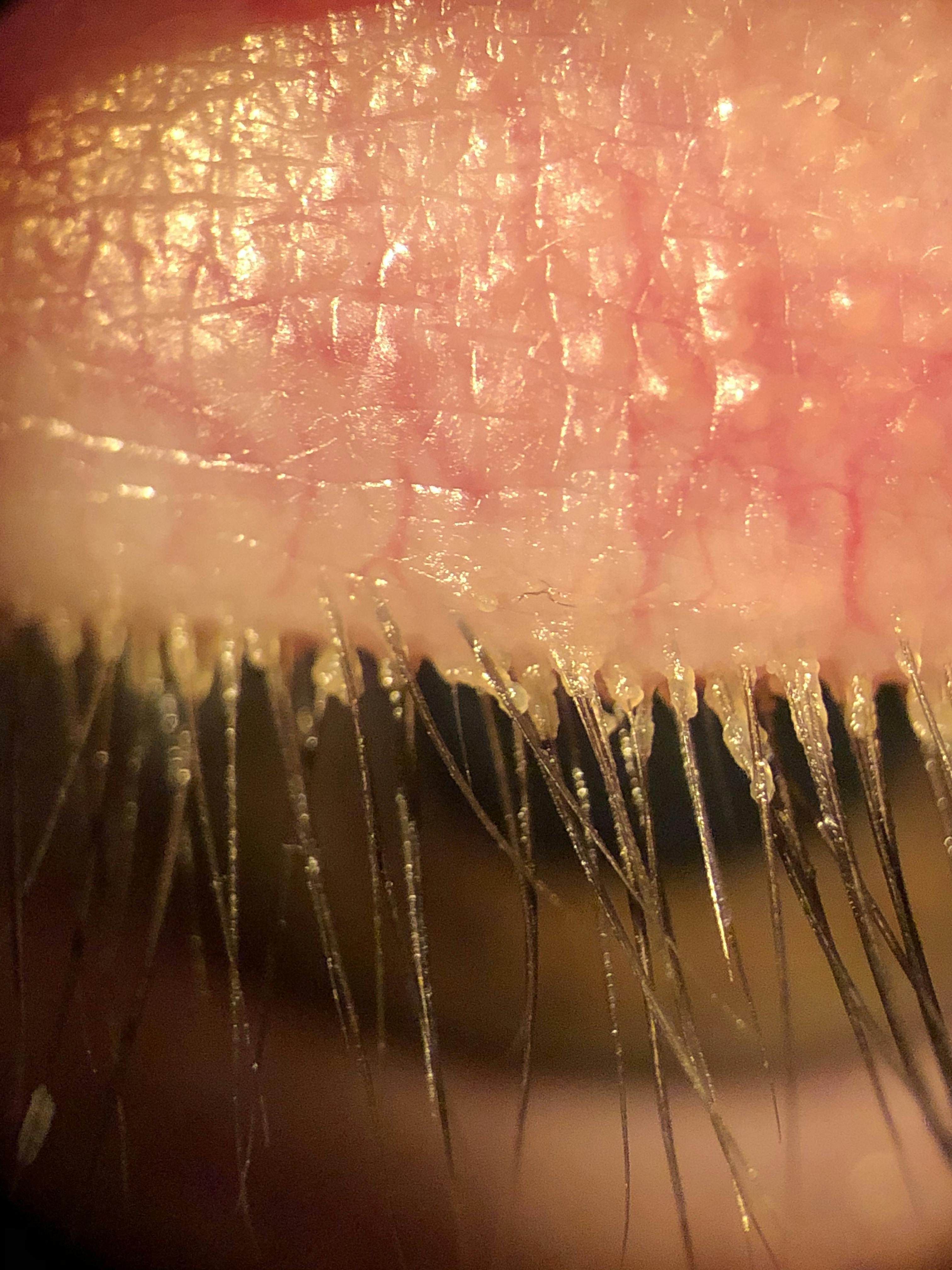 https://covalentcareers3.s3.amazonaws.com/media/original_images/New_Figure_12_Demodex_Blepharokeratoconjunctivitis_photo.JPG