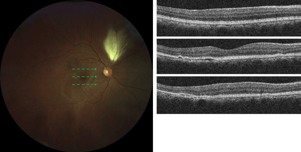 https://covalentcareers3.s3.amazonaws.com/media/original_images/OCT-B-Scan-of-Retinal-Loci.png