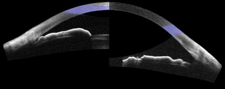 https://covalentcareers3.s3.amazonaws.com/media/original_images/OCT-of-Angle-Before-and-After-Cataract-Surgery.png