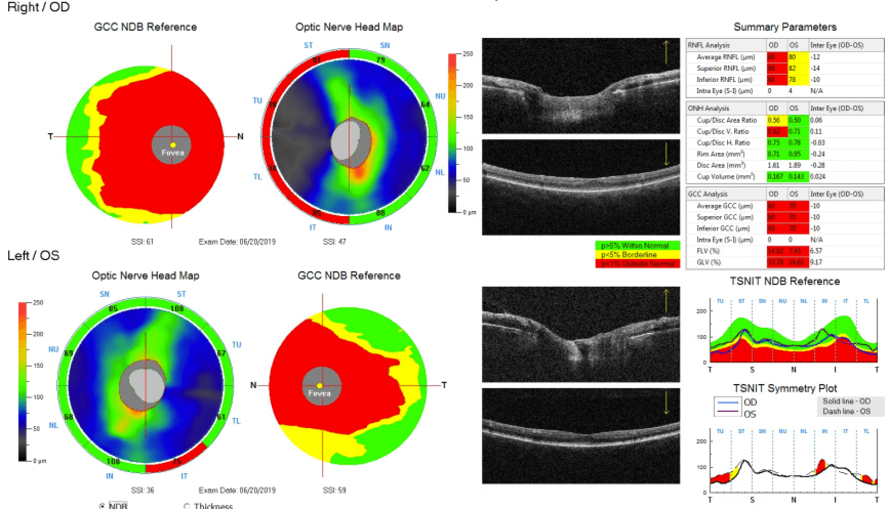 https://covalentcareers3.s3.amazonaws.com/media/original_images/Optic_Neuritis_OCT_OD_and_OS.png