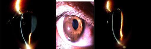 https://covalentcareers3.s3.amazonaws.com/media/original_images/Pellucid_marginal_corneal_degeneration.png