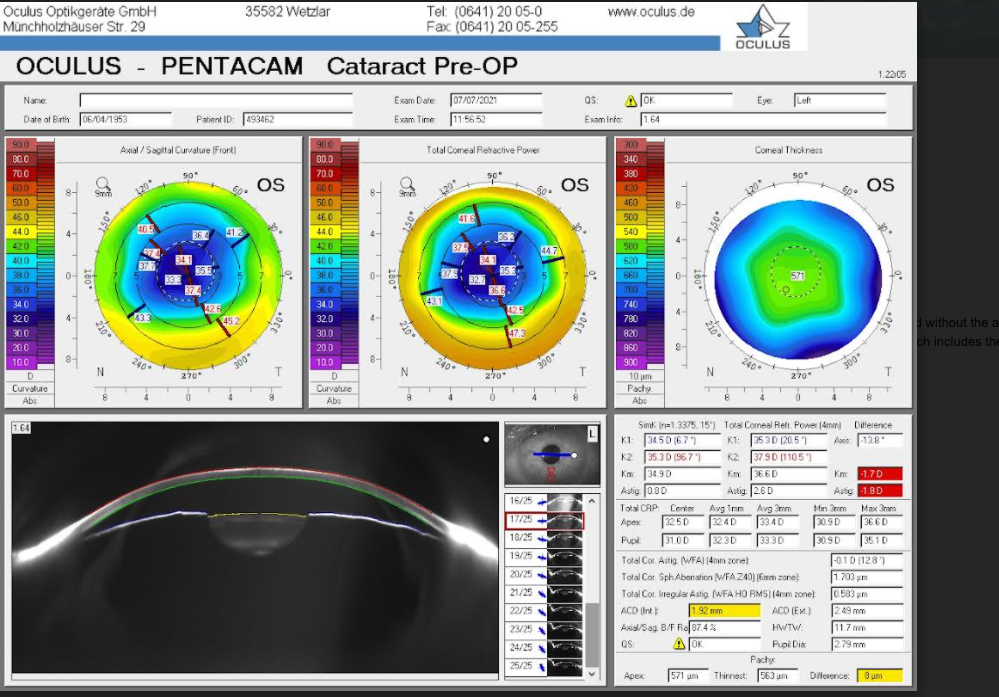 https://covalentcareers3.s3.amazonaws.com/media/original_images/Pentacam-image-post-astigmatism.png