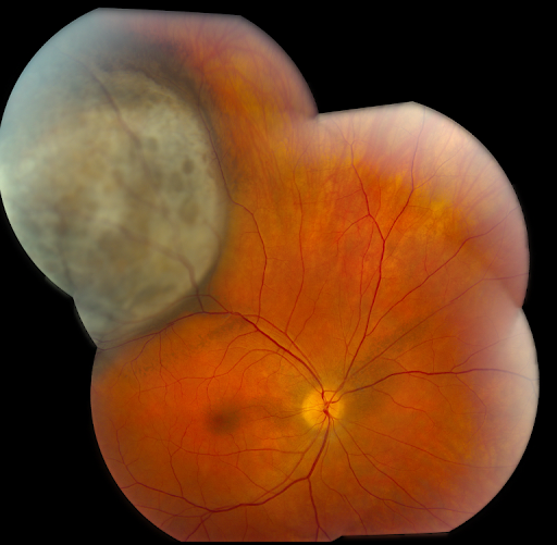 https://covalentcareers3.s3.amazonaws.com/media/original_images/Primary_Choroidal_Melanoma_yUlVLMz.png