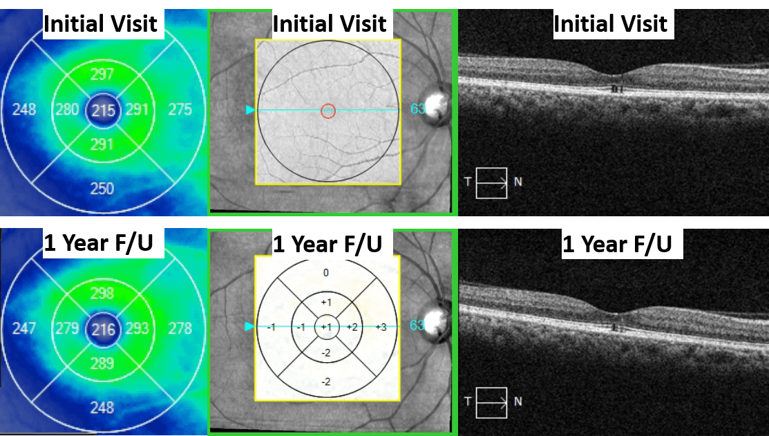 https://covalentcareers3.s3.amazonaws.com/media/original_images/Solar_Retinopathy_4a.png