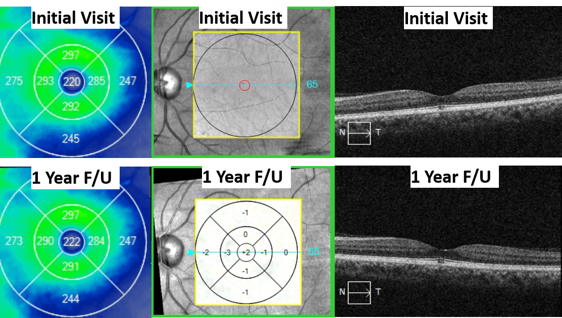 https://covalentcareers3.s3.amazonaws.com/media/original_images/Solar_Retinopathy_4b.png