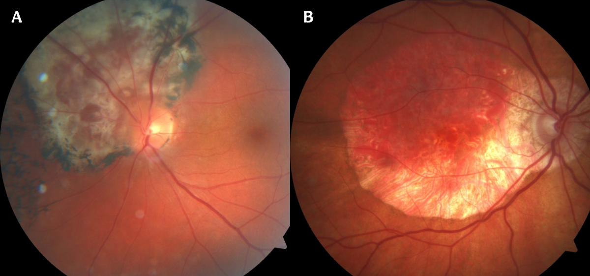 https://covalentcareers3.s3.amazonaws.com/media/original_images/The-Ultimate-Guide-to-Diagnosing-a-Choroidal-Nevus_Images_Choroidal-Hemang.png